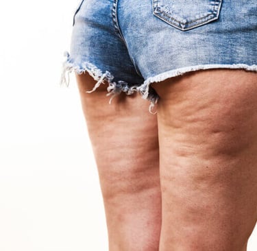 cellulite