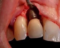 Peri-implantitis (dental implant infection)