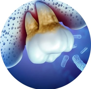 Soin naturel parodontite jet dentaire ozone Aquolab hygiene-precision.com