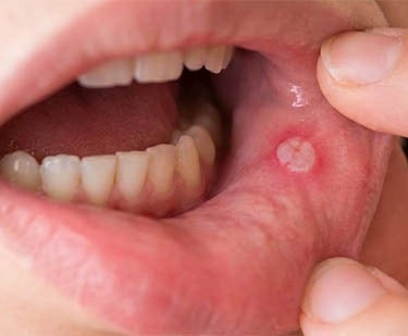 Stomatite Aphteuse hygiene-precision.com