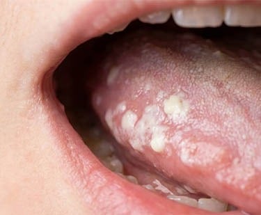 Stomatite Candidosique hygiene-precision.com