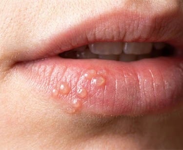 Stomatite Herpétique hygiene-precision.com