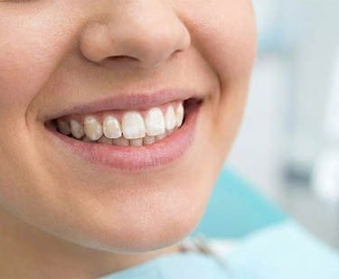 Taches blanches sur les dents hygiene-precision.com