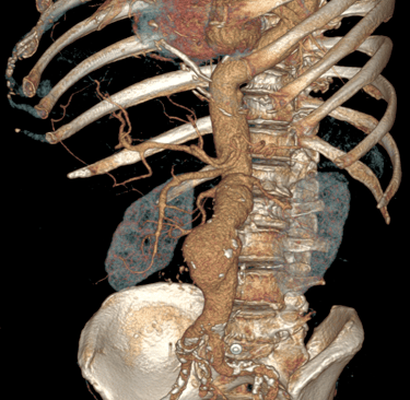 Anévrisme de l'aorte abdominale