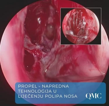 propel-implantat-operacija-sinusa-fess