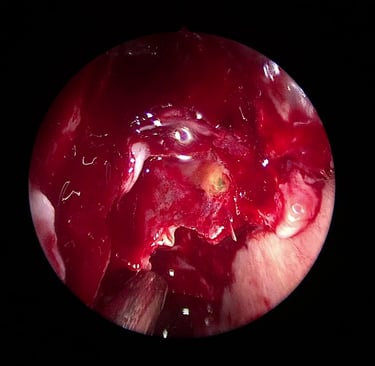 Endoskopski prikaz curneja likovra obojanog fluoresceinom