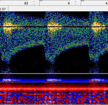Transcranial Doppler TCD waveforms bruit vasospasm