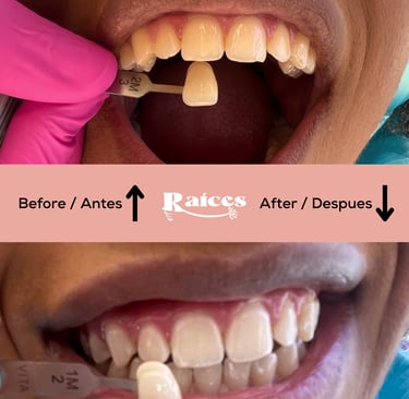 blanqueamiento dental tenerife