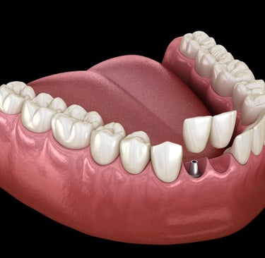 Cantilever Implant Bridge