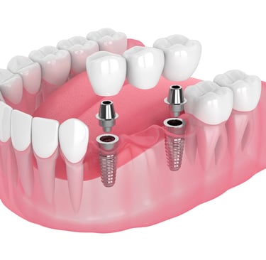 dental implant bridge