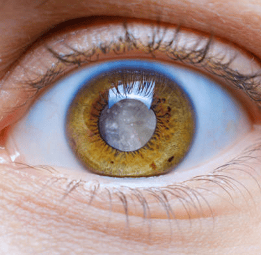 Cataract Eye