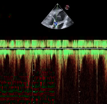 Ecocardiografía Doppler con señal espectral, evaluación de flujo cardiaco