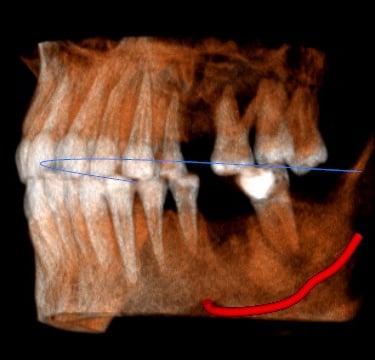 picture of a CBCT xray