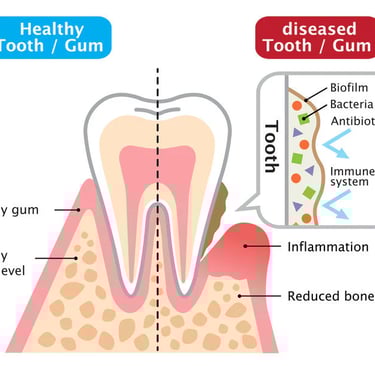 a diagram of a tooth and inflammation