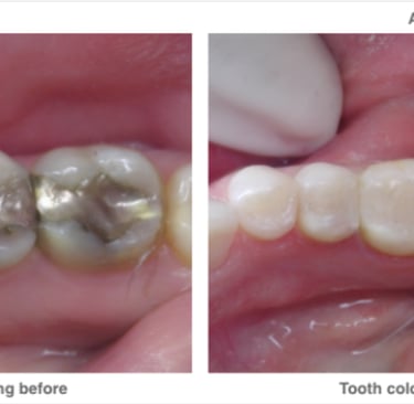 before and after - removal of amalgam fillings