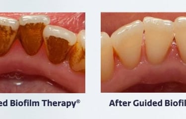 picture of dental staining removal