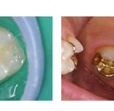picture of dental gold fillings