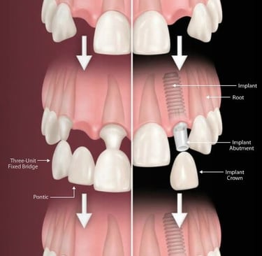 diagram of bridge versus implant therapy