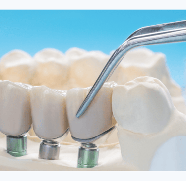 implant crown picture