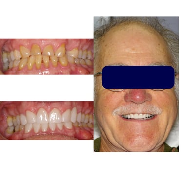 collage of man with dental restoration