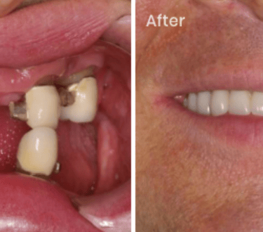 picture of a man with a denture