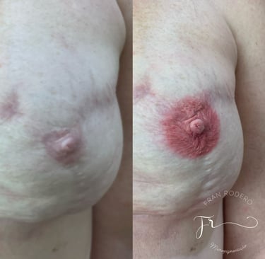 reconstrução de cicatriz tatuagem paramédica