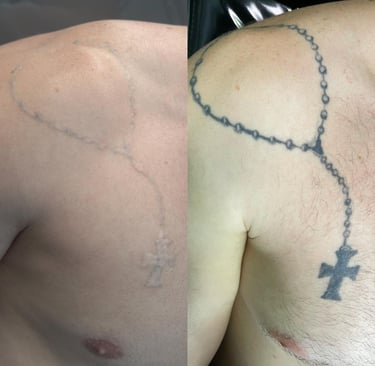 remoção de tatuagem em homens