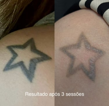 resultado após três sessões de remoção a laser 