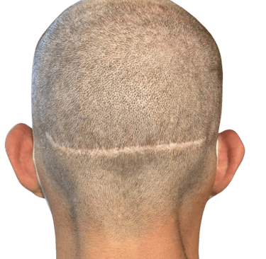 Cicatrice due à une greffe de cheveux pouvant être effacée par la tricopigmentation