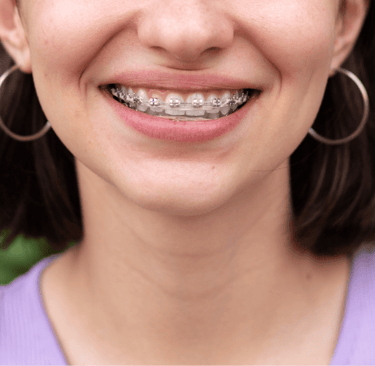 Teeth straightening options