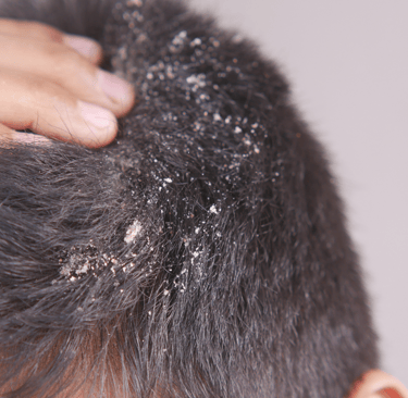 dandruff