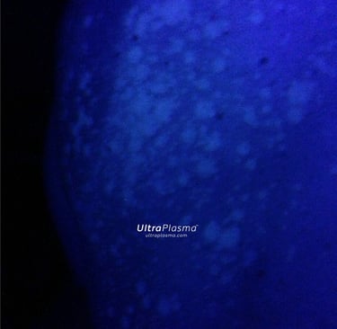 ultraplasma.com Tinea Versicolor woodlamp diagnosis