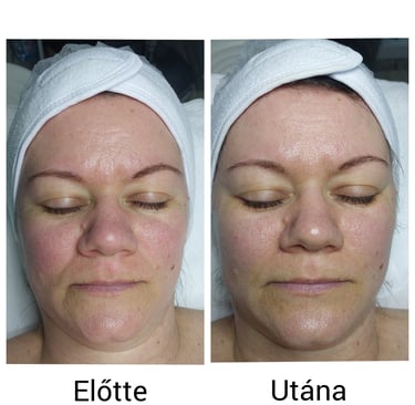 C vitaminos arckezelés veszprémben