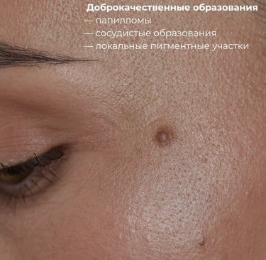Удаление папилом