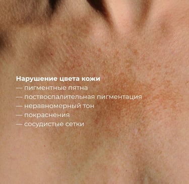 Борьба с пигментацией, рубцами и сосудистыми сеточками