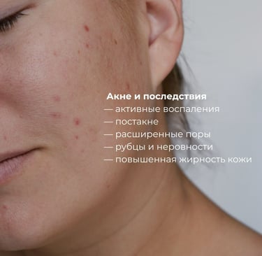 Лечение акне и разглаживание рубцов