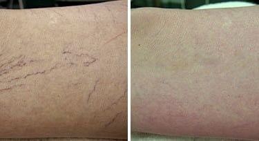 Confronto prima e dopo trattamento capillari TRAP per rigenerazione venosa gambe Torino VenaPelvic.