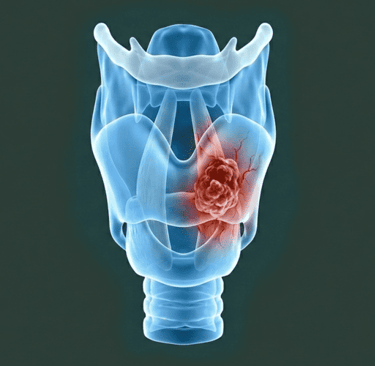 Ilustración médica de cáncer de laringe que muestra un tumor en las cuerdas vocales en la laringe