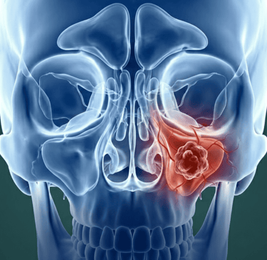 Ilustración anatómica en 3D de un cráneo humano que muestra un tumor del seno maxilar en rojo.
