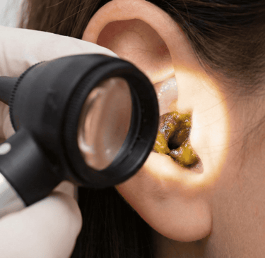 paciente con tapon de cerumen siendo revisada por otorrinolaringologo en consultorio