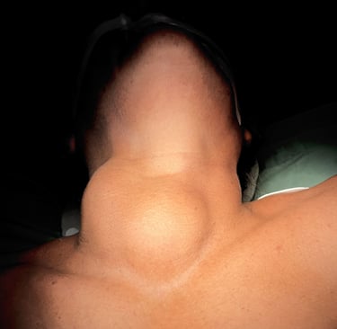 Un bocio tiroideo grande o una masa en el cuello de un paciente durante un examen médico