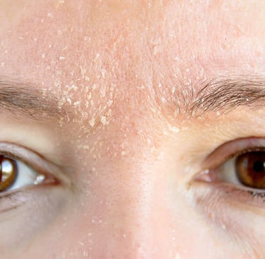 kuru cilt döküntü