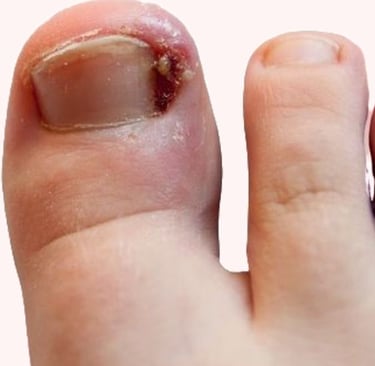 TRATAMENTO UNHA ENCRAVADA EM BH