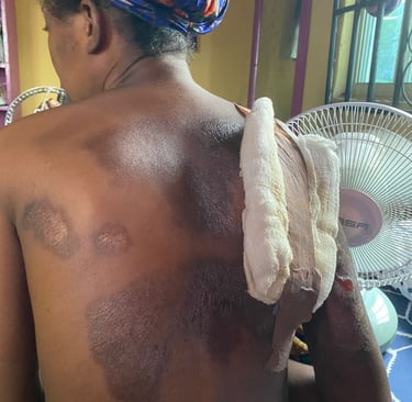 In the hospital. One of the lesbians with the wounds received from the beating by the mob.