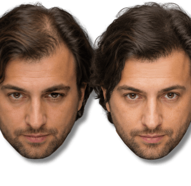 Before and after comparison of a man's SMP showing improved hair density and volume.