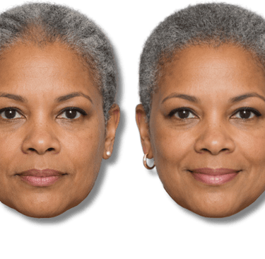 Before and after comparison of a woman showing improved hair density results.