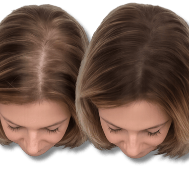 Before and after comparison of SMP treatment showing increased scalp coverage and volume.