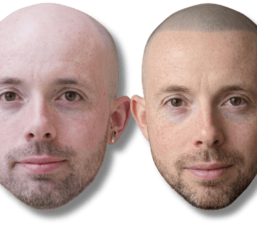 Before and after results of scalp micropigmentation for a natural-looking hairline and hair density.