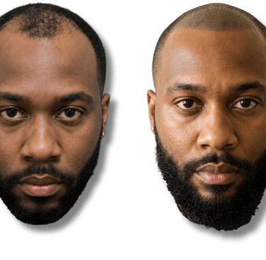 Before and after scalp micropigmentation for a man with thinning hair and a full beard.