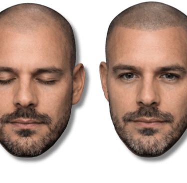 Before and after scalp micropigmentation for men showing a natural hairline and thicker hair appearance.